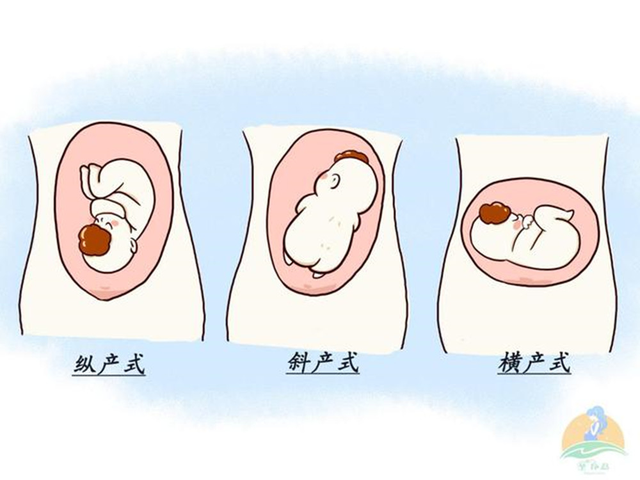 胎位不正纠正图姿势，八个月胎位不正纠正图（“胎位不正”别太心焦）