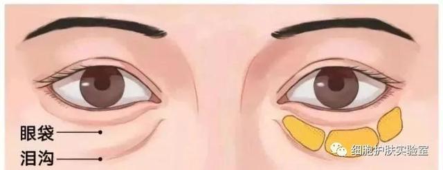泥奏凯是什么意思，皱纹小百科-泪沟，泥奏凯