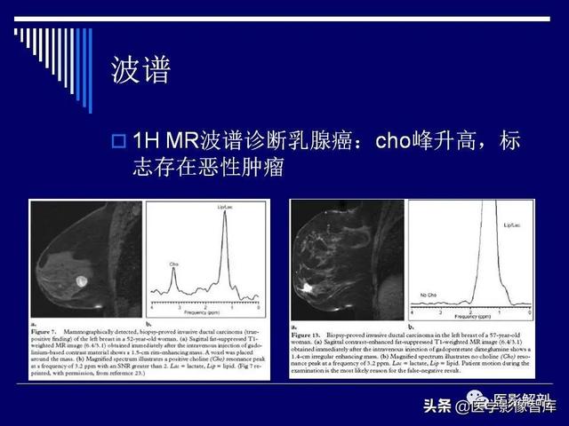 乳房解剖学基础知识，乳腺解剖及乳腺各病变影像诊断与鉴别