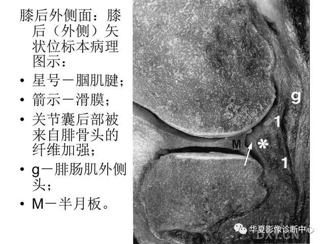 膝关节解剖结构图，膝盖解剖图示意图（膝关节MRI之正常解剖综述）