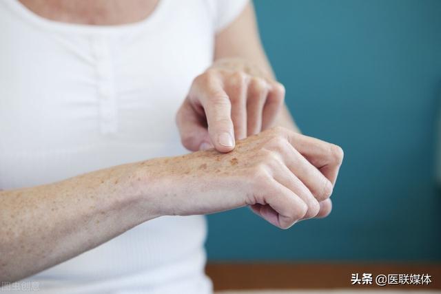 去老年斑的方法，去老年斑的方法有哪些（为何年纪大了，就会长老年斑）