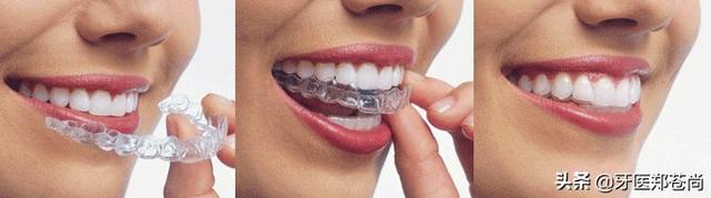 隐形矫正牙齿多少钱，隐形牙齿矫正大概需要多少钱（隐形的牙套会不会比钢丝的花费时间要长呀）