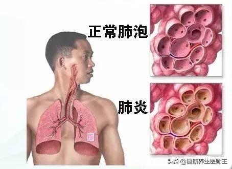 关于变形杆菌属介绍，变形杆菌有哪几种（医院内获得性肺炎）