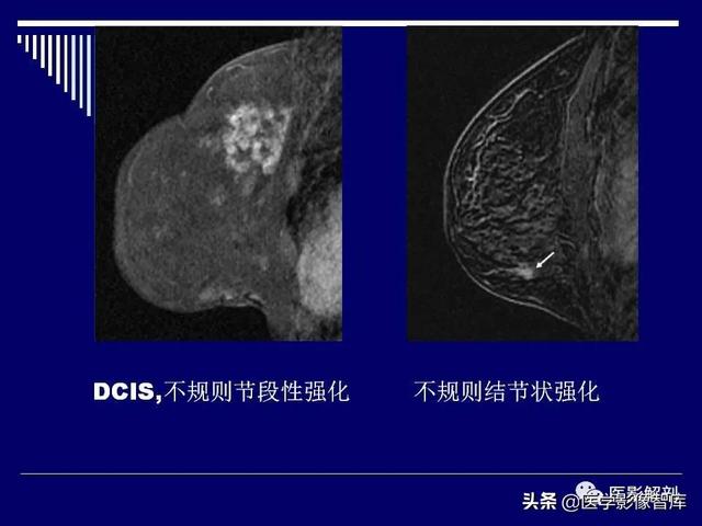 乳房解剖学基础知识，乳腺解剖及乳腺各病变影像诊断与鉴别