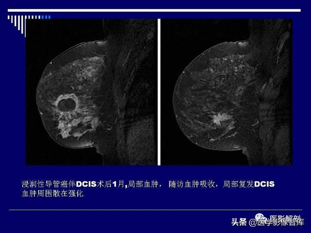 乳房解剖学基础知识，乳腺解剖及乳腺各病变影像诊断与鉴别