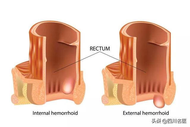 人为什么会痔疮，人为什么会长痔疮（医生：4大高危因素你占几个）
