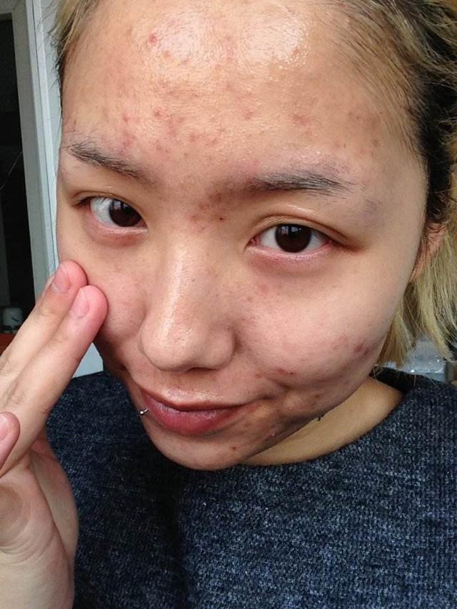 芦荟祛痘方法是什么，芦荟祛痘方法是什么意思（教你3个祛痘植物配方）