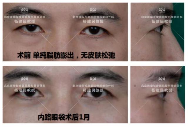 大眼袋怎么消除，大眼袋怎么消除（整形医生教您如何去除“大眼袋”）