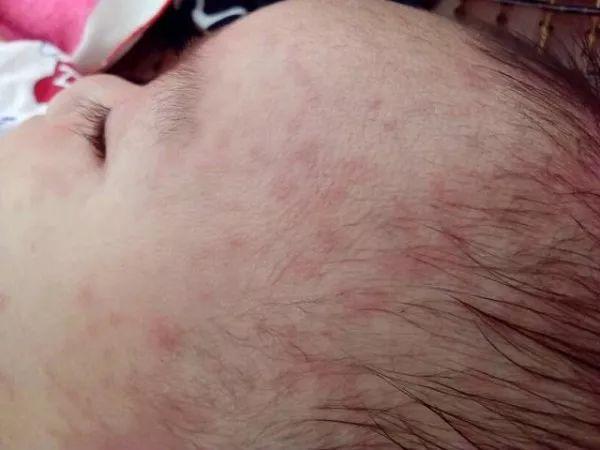 新生儿皮肤起红疹子怎么办，宝宝发烧出疹子