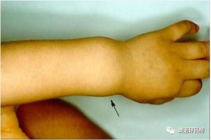 顶骨凸起 面相,佝偻病的症状和临床特点 - 玉三网