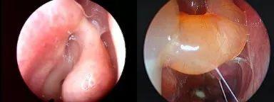 鼻窦炎微创手术，鼻窦炎微创手术价格是多少（诊治及【合理用药）