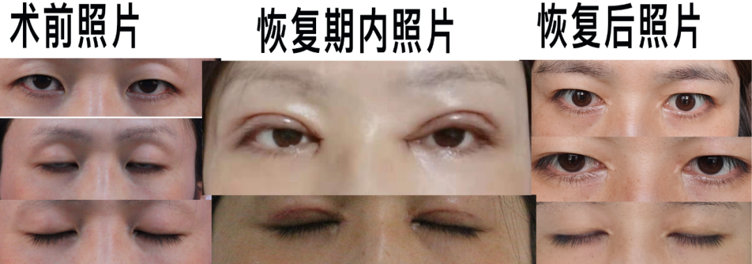 开眼角失败案例（整形）