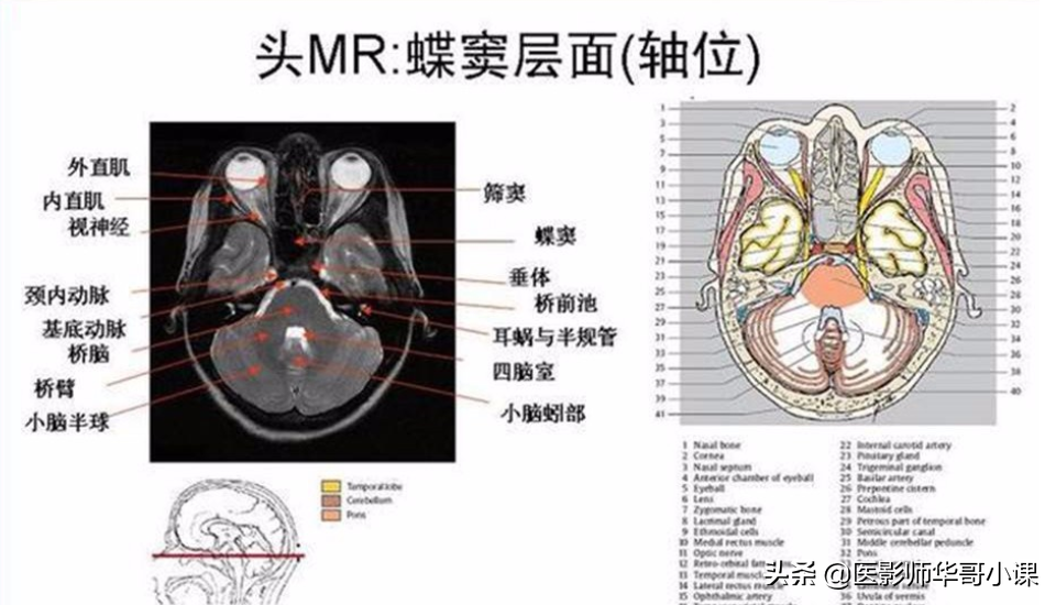 颅脑mri(头部MRI)插图(78)