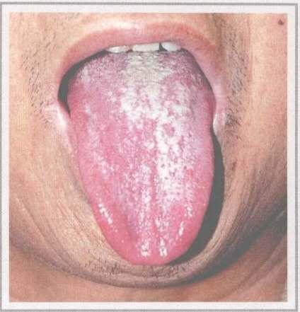 分为:花剥苔:舌苔部分剥落