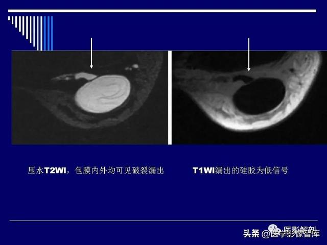 乳房解剖学基础知识，乳腺解剖及乳腺各病变影像诊断与鉴别