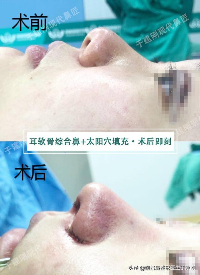 一张图看懂鼻基底凹陷对比图，塌鼻秒变立体质感鼻