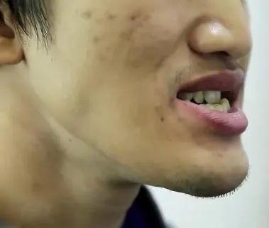 地包天是什么样子的,"地包天"需不需要及时治疗-相术-荣耀易学