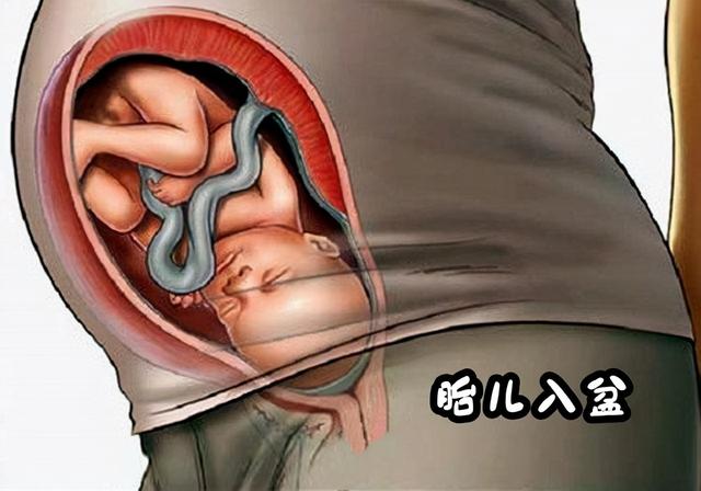 宝宝入盆后的肚型图片，宝宝入盆后的肚型图片左枕前（5感觉+3变化说明胎儿已入盆）