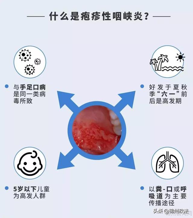 口腔上颚靠咽喉部一堆小疹子，宝宝喉咙上颚有小红点的原因（疱疹性咽峡炎来了）