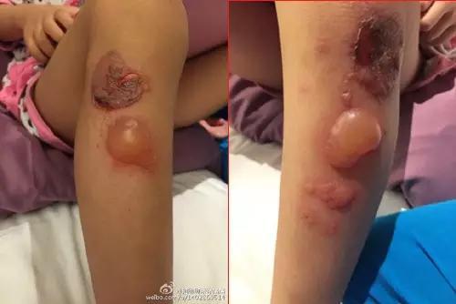 三伏贴的副作用，如何健康使用三伏贴（三伏贴致92名儿童出现不良反应）