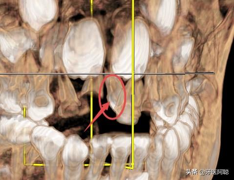 上门牙多生牙图片(多生牙的治疗最佳治疗方法)插图(3)