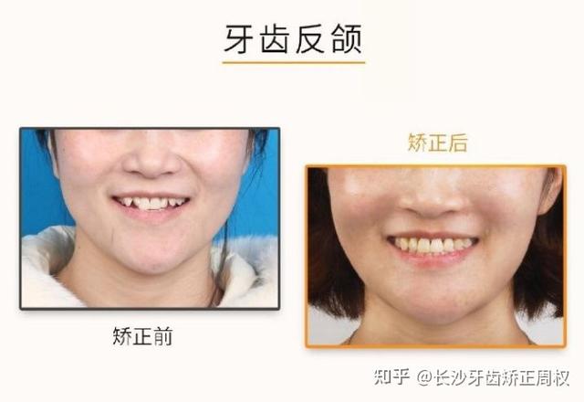 前牙反合是因什么导致的呢，前牙反合的病因（什么是反颌<地包天>）