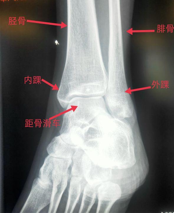 脚踝是哪个部位图解，脚踝是哪个部位图解视频（学习《X线读片指南》骨、关节系统——踝关节）