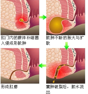 肛门里长肉芽是怎么回事,北京东大肛肠医院肛门口流脓是怎么回事 - 玉