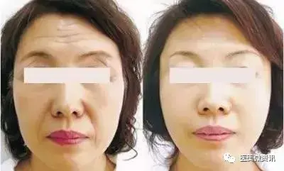 玻尿酸去皱纹好吗，玻尿酸去皱纹多少钱（玻尿酸解决静态皱纹）