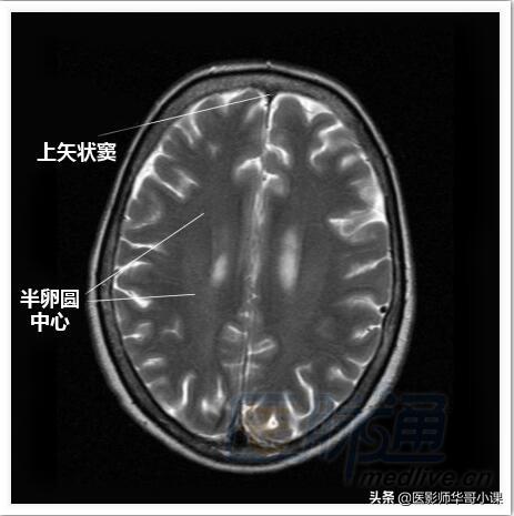 颅脑mri(头部MRI)插图(11)