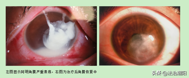 眼睛被虫子撞了会自己好吗，少年这个动作导致角膜溃疡流脓