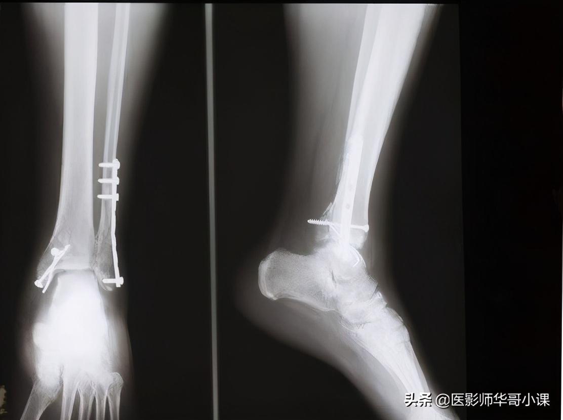 尺骨桡骨怎么区分，怎样分辨尺骨和桡骨（骨关节记忆要点，请收藏）