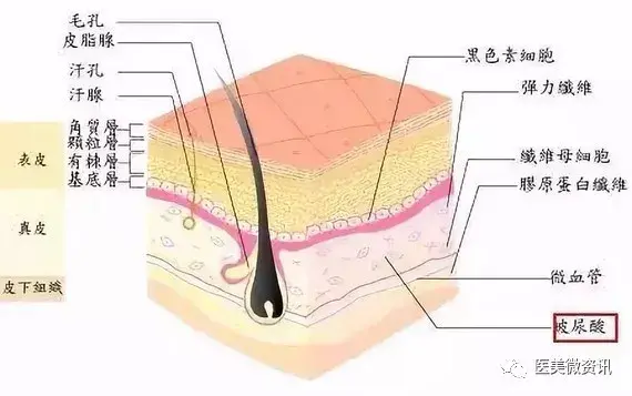 玻尿酸去皱纹好吗，玻尿酸去皱纹多少钱（玻尿酸解决静态皱纹）