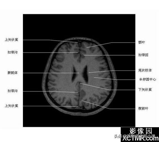 颅脑mri(头部MRI)插图(45)