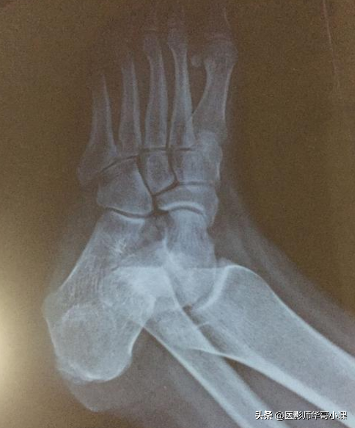 尺骨桡骨怎么区分，怎样分辨尺骨和桡骨（骨关节记忆要点，请收藏）