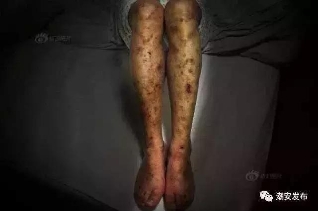 毒品对人体的危害，毒品有哪些危害（为什么说吸毒对人产生的危害是毁灭性的）