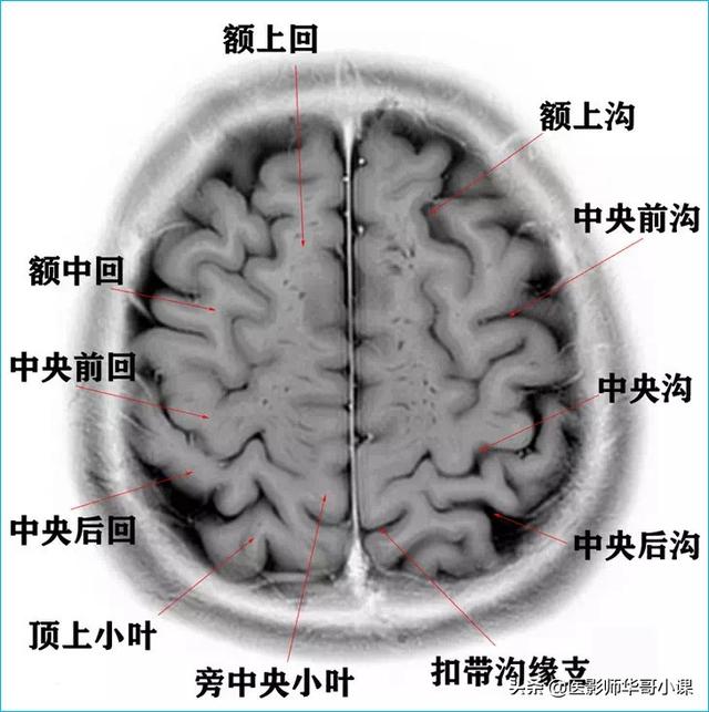 头颅ct解剖图，头部骨骼结构图（颅脑磁共振MRI解剖结构以及高清图谱）