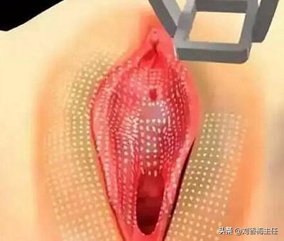 阴唇漂红手术缺点有哪些，漂唇后注意哪些怎么样护理（私密漂红有副作用吗）