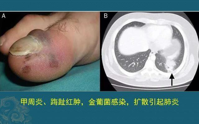 碘酒过期了还能用吗，过期了的碘酒还能不能用（硬扛3天不吃抗生素必后悔）