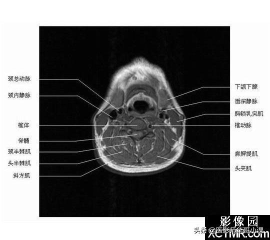 颅脑mri(头部MRI)插图(54)