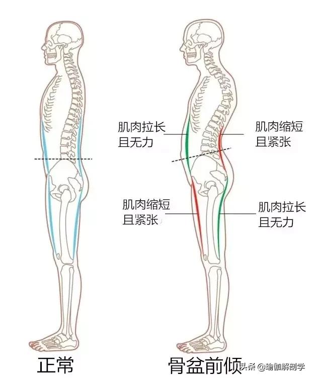 骨盆前倾怎么办，骨盆前倾三种办法（3个小动作缓解你的骨盆前倾）