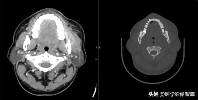 颞间隙感染，颞间隙感染切开部位（颌面部间隙感染影像诊断及各间隙解剖介绍）