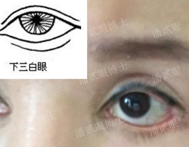 三白眼是什么意思，下三白眼的女人（下睑下至注意分寸）