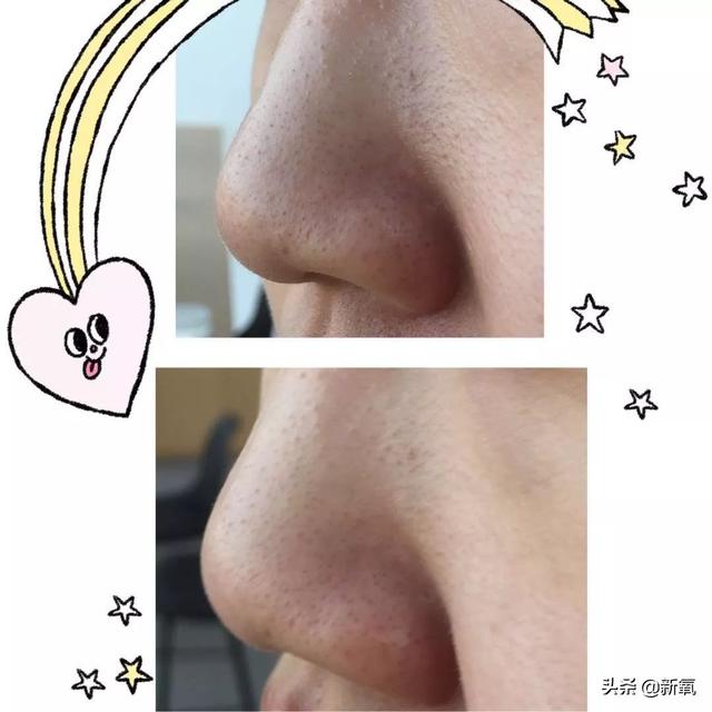 怎么去黑头小窍门，五个去黑头方法（我把火爆全网的去黑头方法试了一遍）