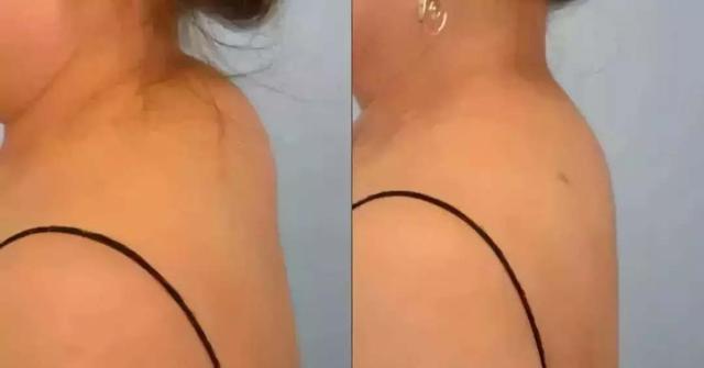 富贵包切除手术恢复需要多久 得了富贵包有必要去医院做手术吗，富贵包切除手术恢复需要多久（富贵包并不是富贵病）