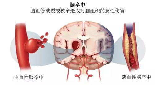 词语卒中的读音，卒中的读音（你可能一样都没搞清楚）