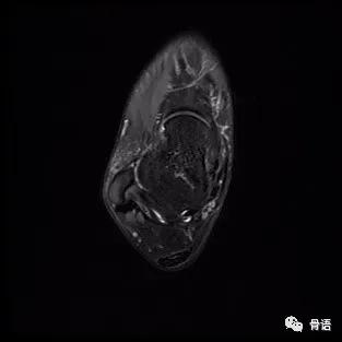 崴脚不拍片怎样判断是否骨折，崴脚怎么判断骨头没事（浅谈“崴脚”你不知道的那点事）