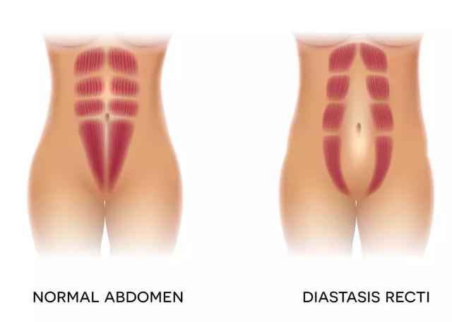剖腹产后肚皮下垂图片，产后肚皮严重松弛下垂图片（这些产后问题不重视）