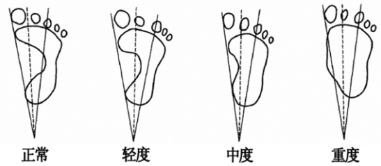 没有脚后跟的人穿鞋穿不住怎么办，没有脚后跟的人怎么穿高跟鞋（扁平足影响日常生活）