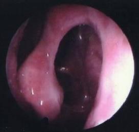 鼻窦炎微创手术，鼻窦炎微创手术价格是多少（诊治及【合理用药）